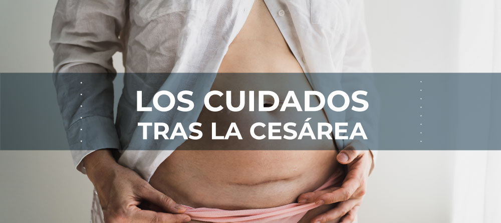 ¿Qué cuidados necesito tras la cesárea?